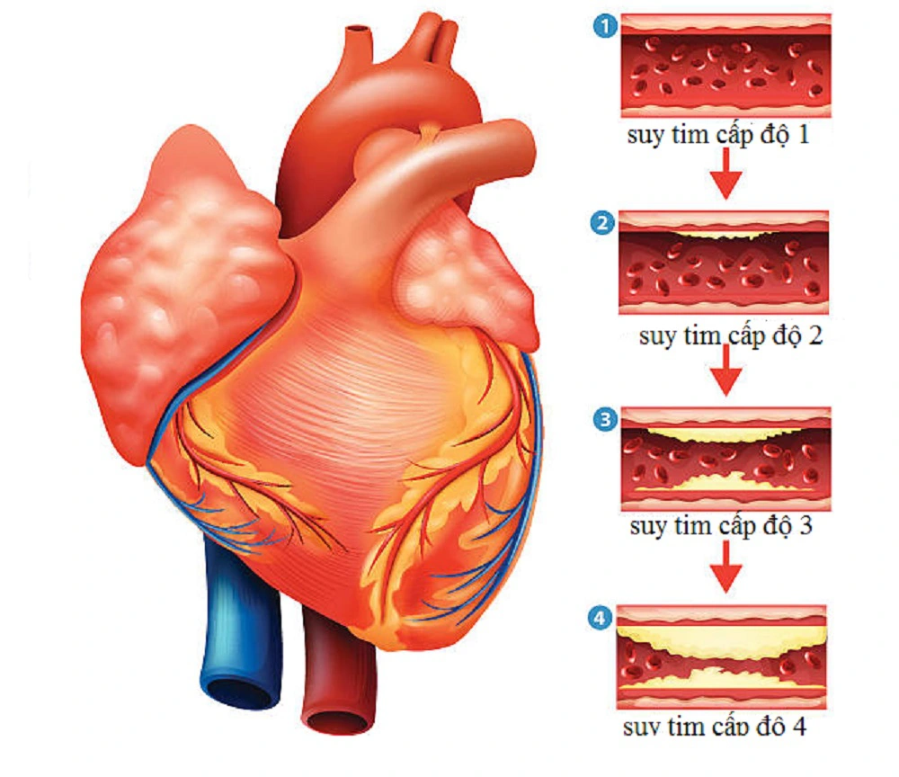 Suy tim độ 2 có nguy hiểm không? Triệu chứng và cách điều trị